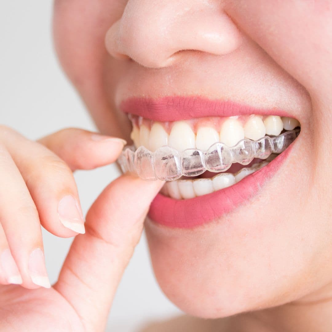 Invisalign Clear Aligners