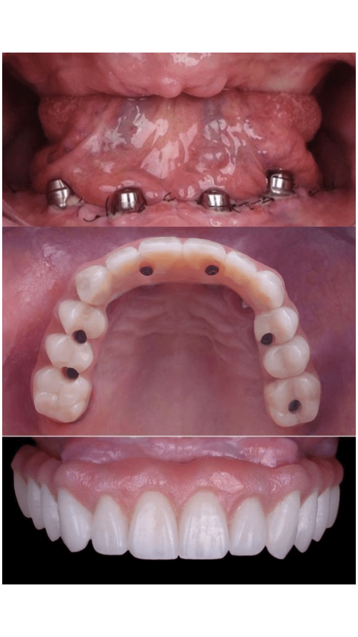Full Mouth Dental Rehabilitation